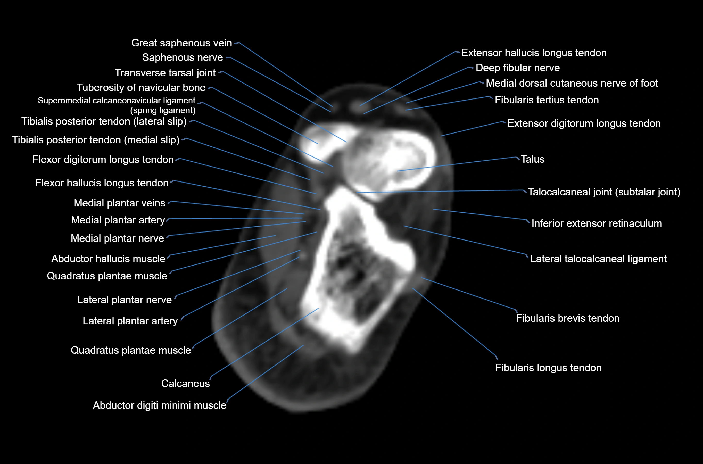 CT Ankle axial cross sectional anatomy labelled image -00041.webp
